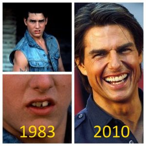 Tom Cruise teeth