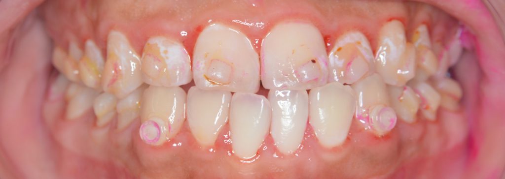 Invisalign Risk aligner with softdrink