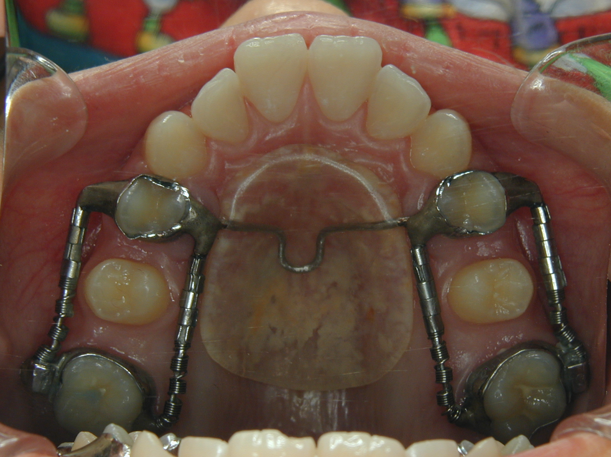 GMD (Greenfield Molar Distalizer)