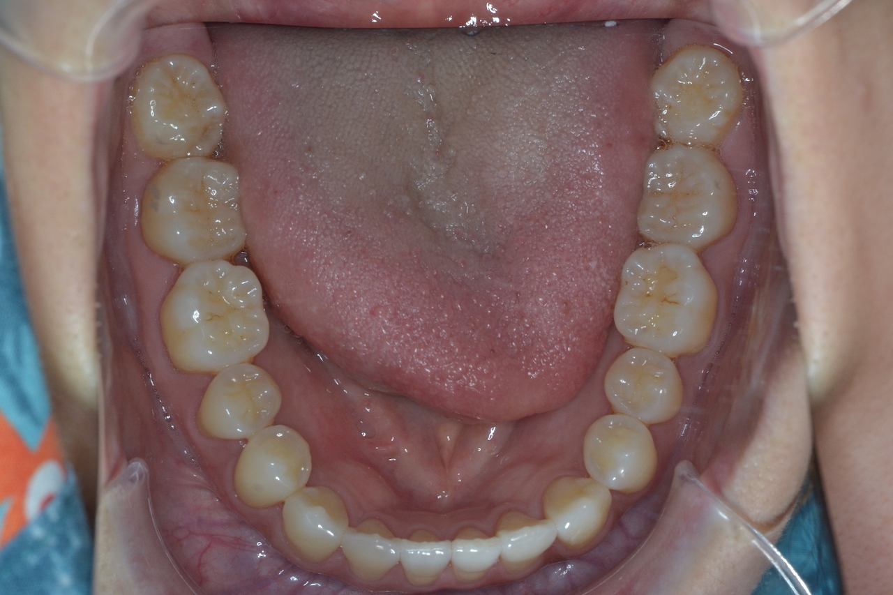 親知らず は抜かないといけないの？ ESmile, ELife