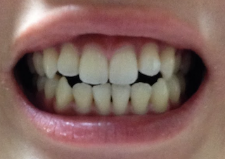 歯並び 綺麗 な 綺麗な歯並びは美人の条件！歯列矯正は大人になってからでも遅くない