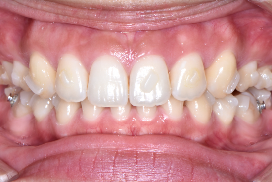 インビザラインのこんな時どうする アタッチメント 編 Oral Powerが世界を変える